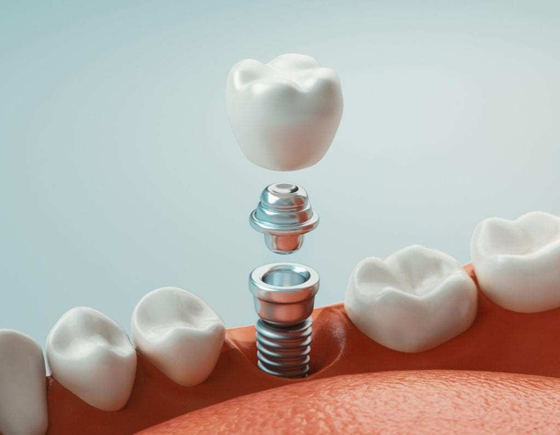 Quy trình cấy ghép implant - Ngắn mão sứ