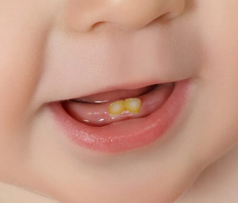 Nguyên nhân răng trẻ 16 tháng bị vàng