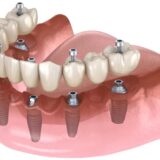 -implant-toan-ham