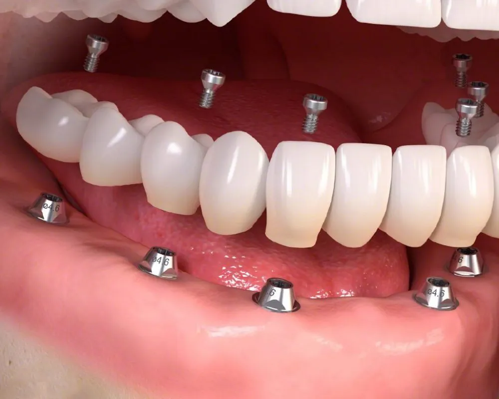 dich-vu-trong-rang-implant-hai-phong-2