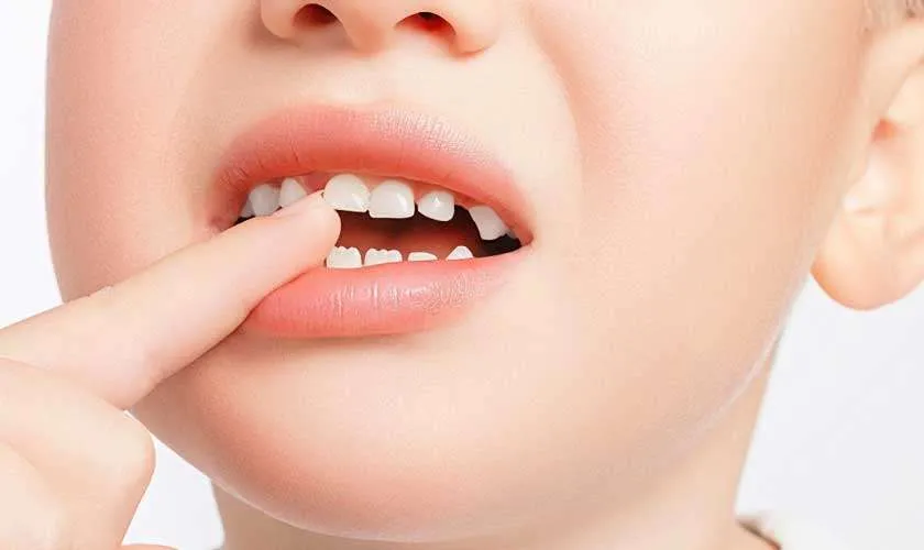 Quy Trình Thay Răng Diễn Ra