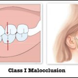 khớp cắn hạng 1