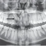 răng mọc ngầm có cần nhổ không