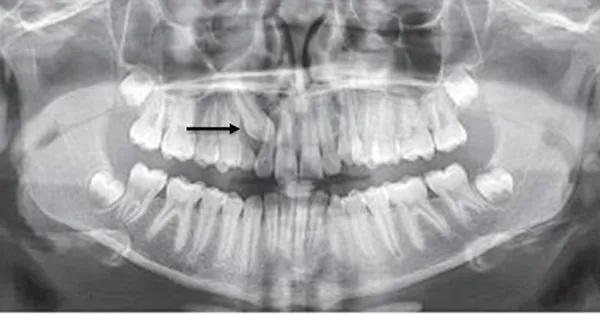 răng mọc ngầm có cần nhổ không