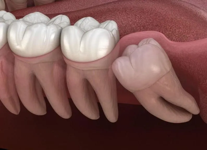 dấu hiệu răng mọc ngầm