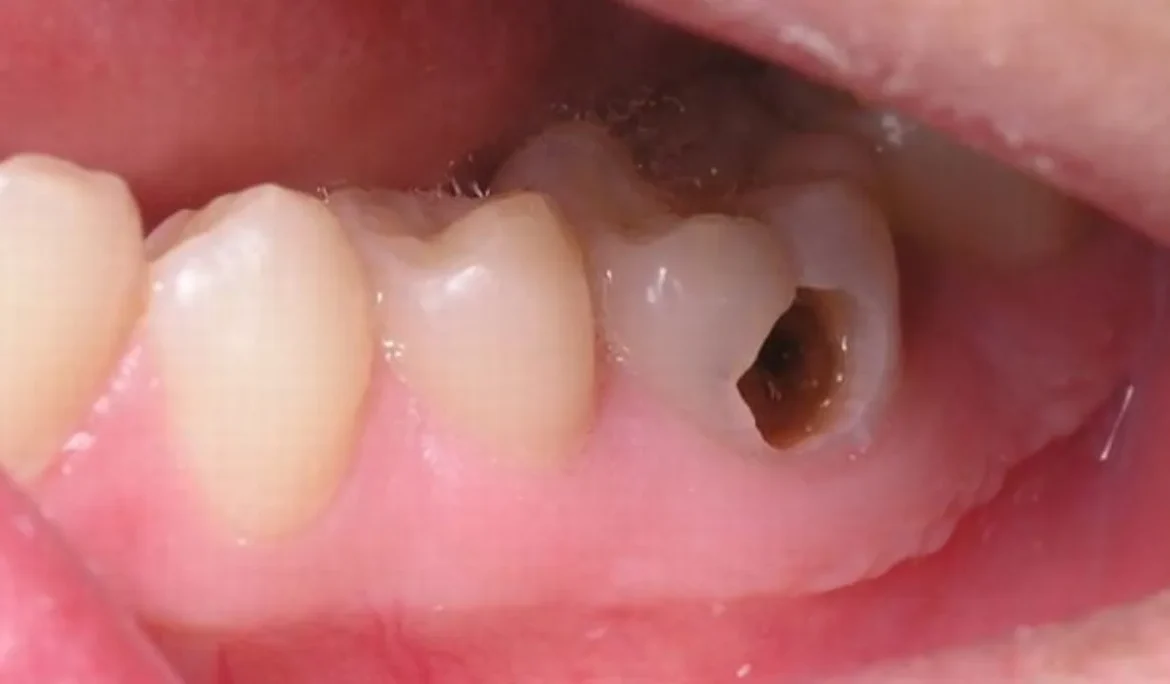 răng số 8 bị sâu có nên nhổ không