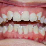 hàm răng dưới không đều